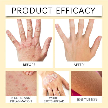 Vitigo Bee Venom Treatment Cream | Natural Skin Repair Hydration Relief Anti-Irritation